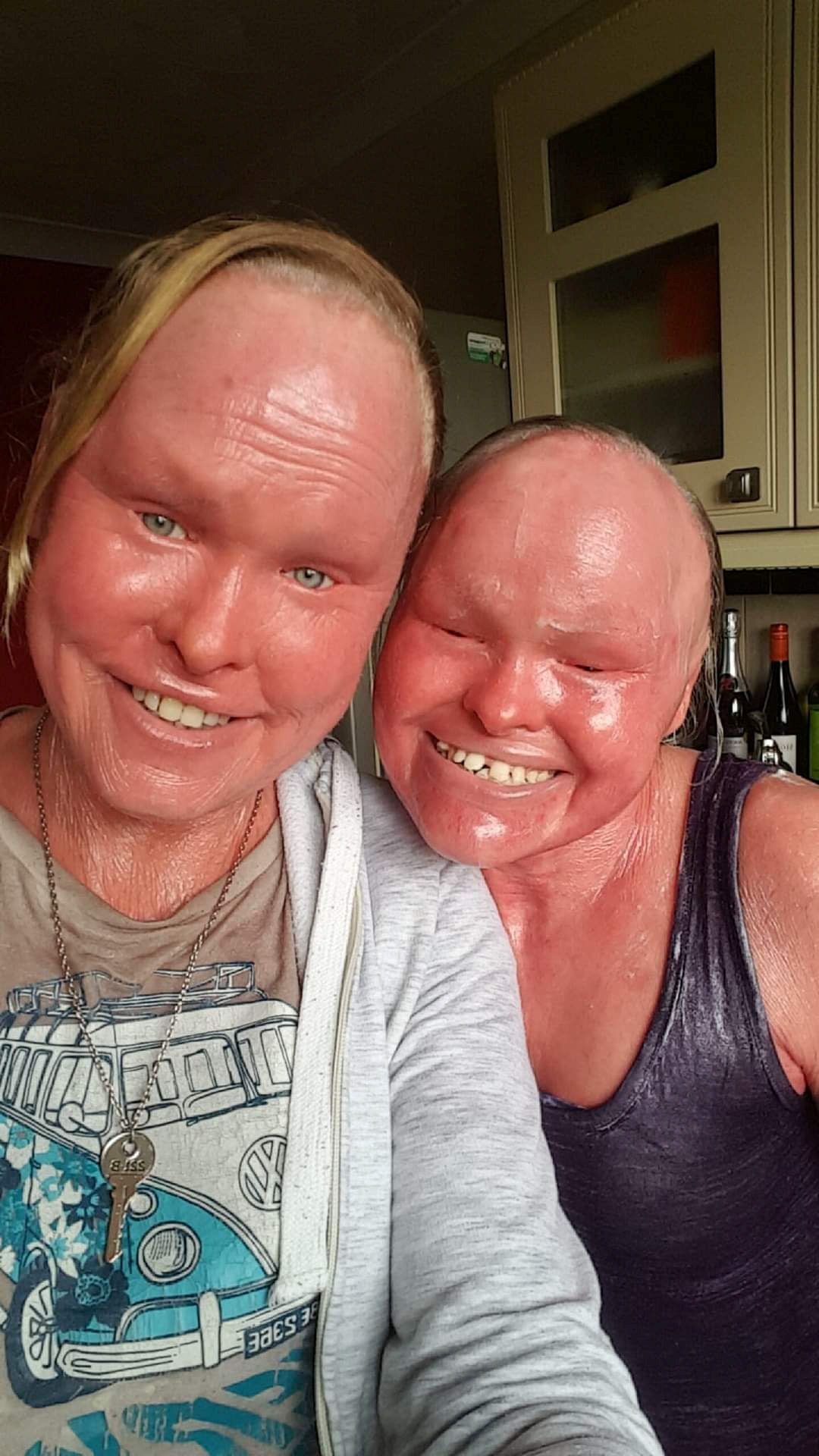 Harlequin Type Ichthyosis Adults