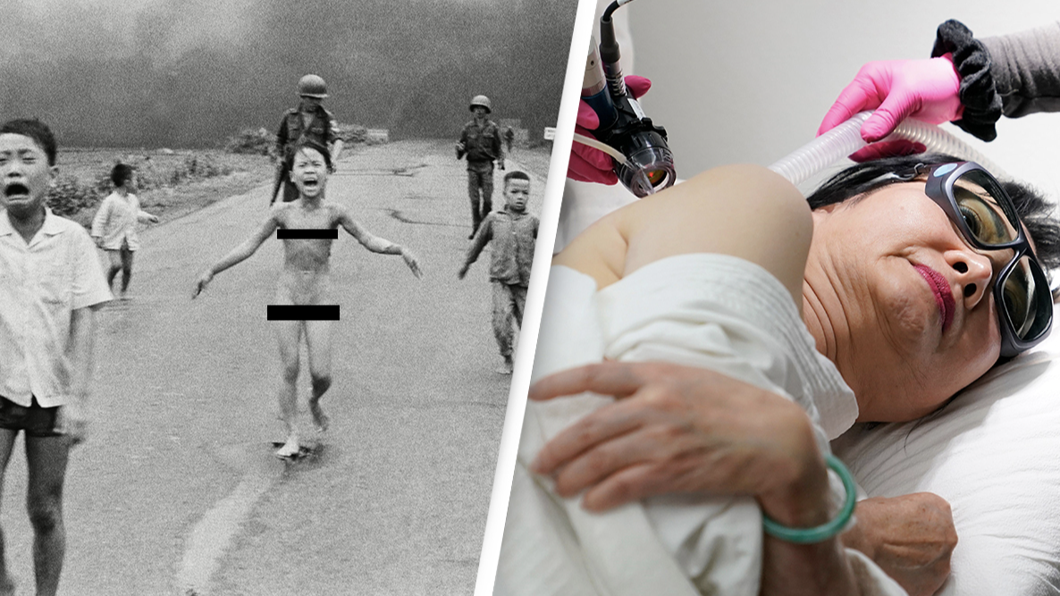 Iconic 'Napalm Girl' From Vietnam War Gets Final Burns Treatment - Vimarsana News