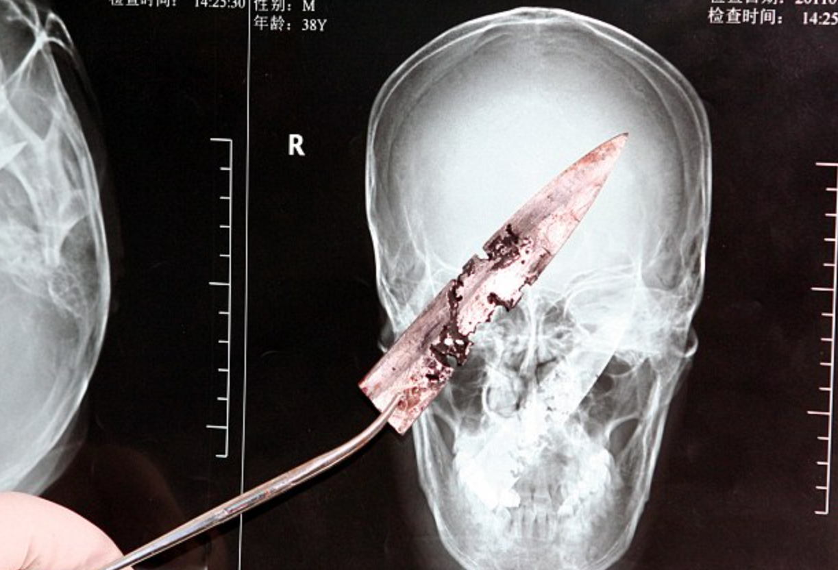 Chinese man who suffered with headaches for years went on to discover he  had a knife stuck in his skull
