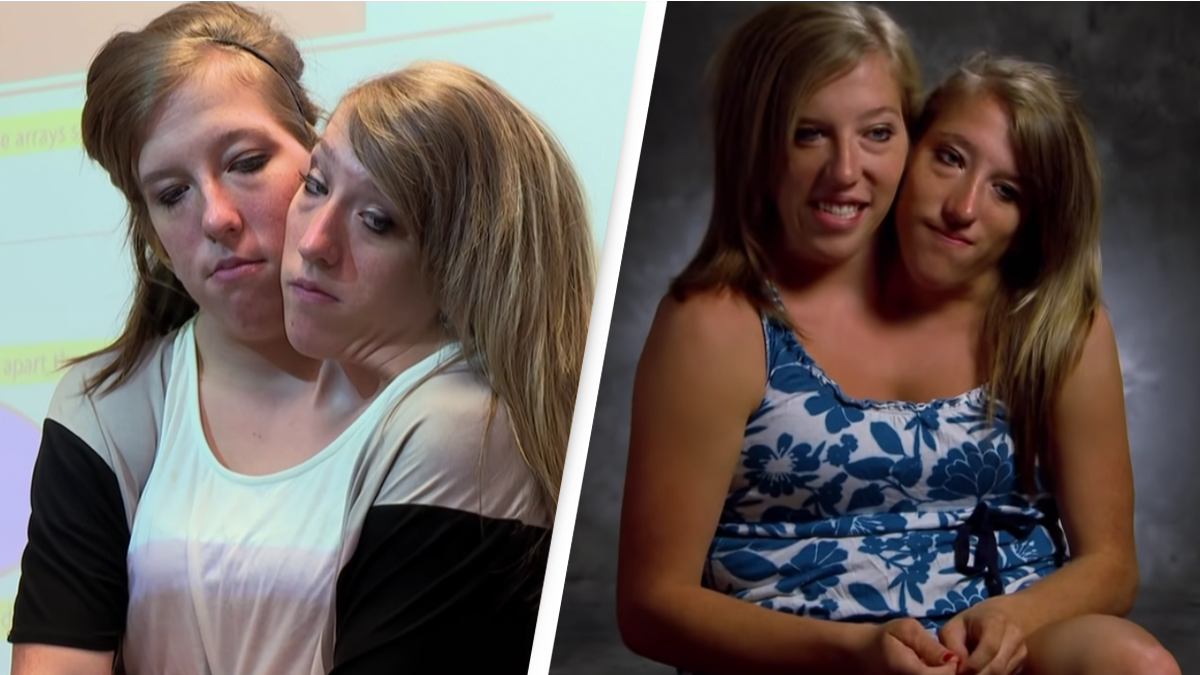 Conjoined twins opened up on what their life was like after becoming  teachers