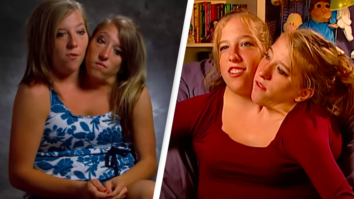 Conjoined twins opened up on what their life was like after becoming  teachers