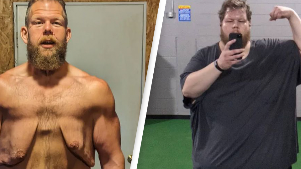 Man who lost nearly 400 pounds but is 'trapped' by his loose skin is close  to reaching his next goal - Health - UNILAD