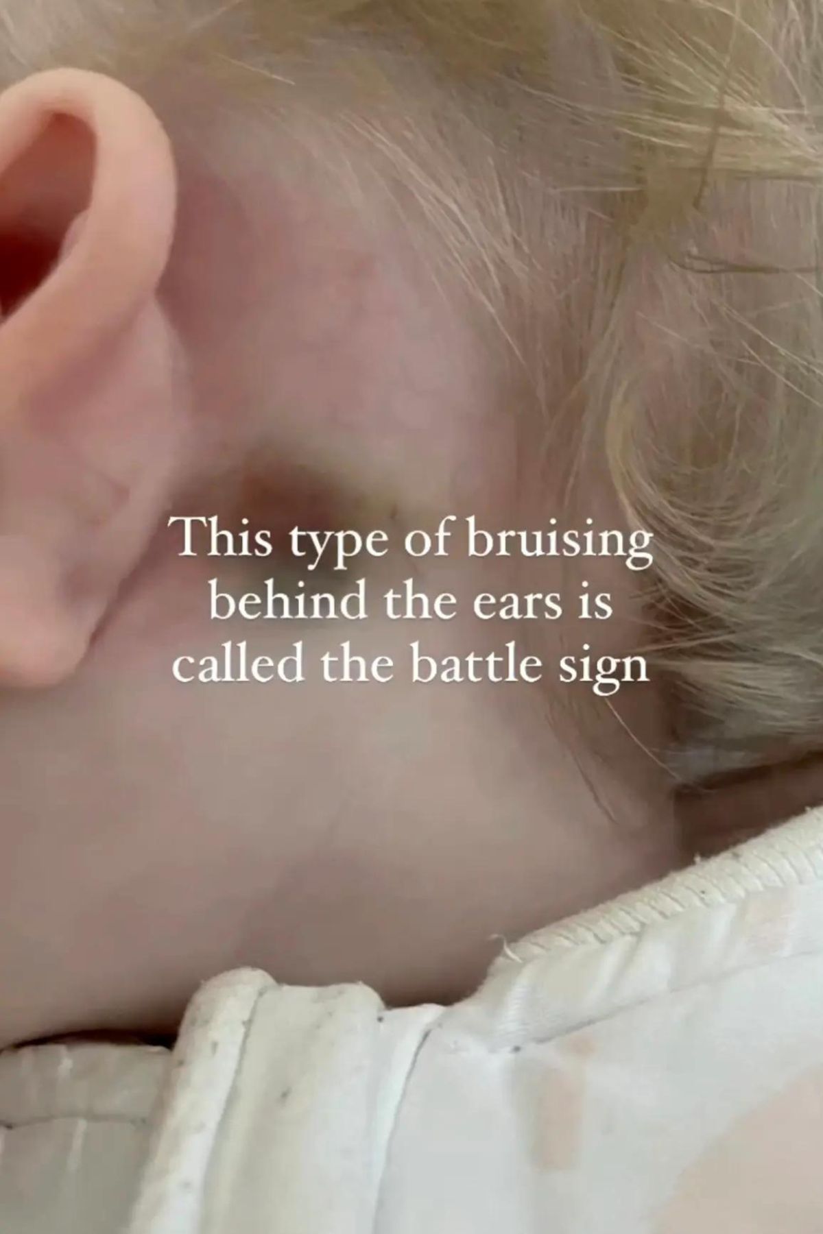 Battle Sign Bruise