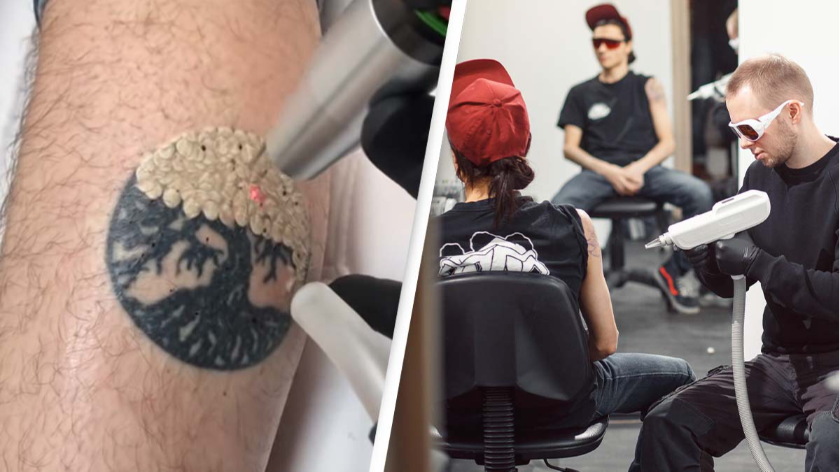 Understanding Laser Tattoo Removal  Skin Survival Laser Clinic Liverpool