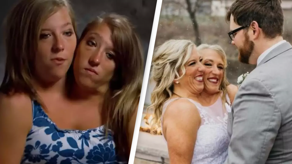 Abby and Brittany Hensel's parents explain why they decided against separating conjoined twins