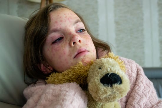 A sick girl with a red skin rash on her face, resting with a stuffed animal.
