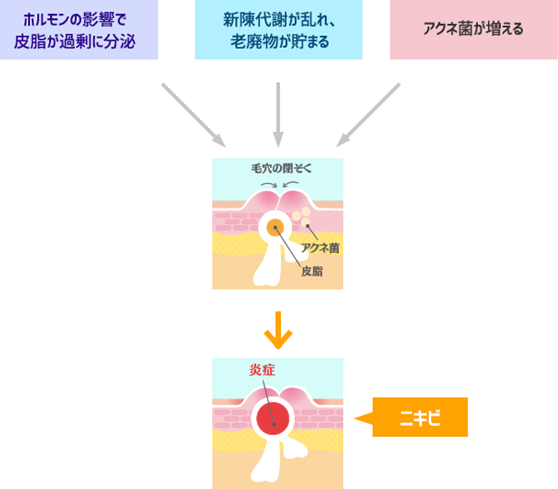 思春期ニキビと大人ニキビって何が違うの？