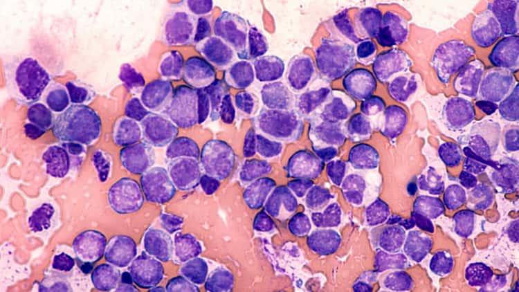 Therapeutic area - Haematology - Hero image Myeloid malignancies Therapeutic area - Haematology - Hero image Myeloid malignancies