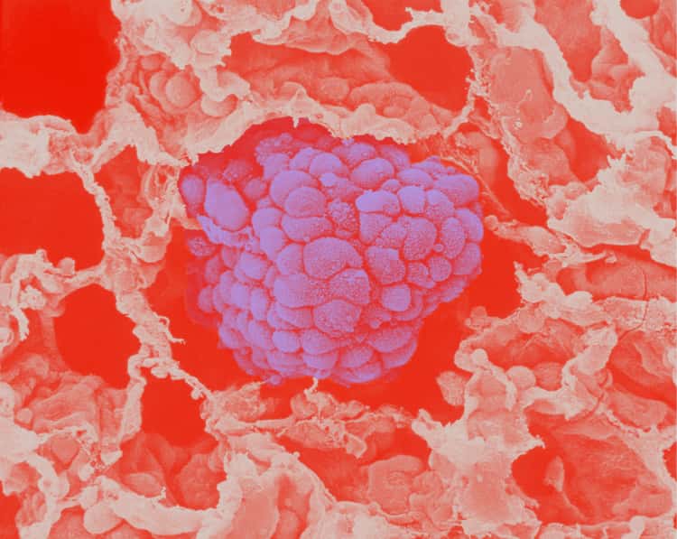 JJ_BodyIllustration_Microscopic_LungCancer_Colorway01 JJ_BodyIllustration_Microscopic_LungCancer_Colorway01