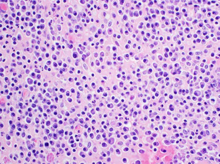 Multiple Myeloma