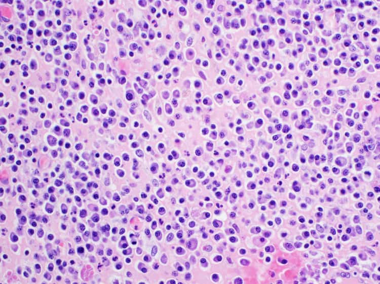 Therapeutic area - Haematology - Hero image MM Therapeutic area - Haematology - Hero image MM