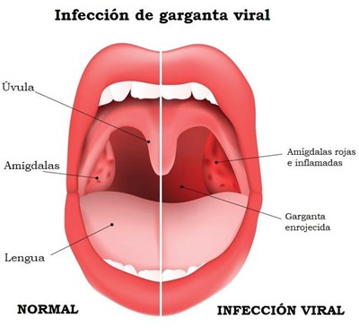tratamiento-amigdalitis-viral_strefen-1.jpg