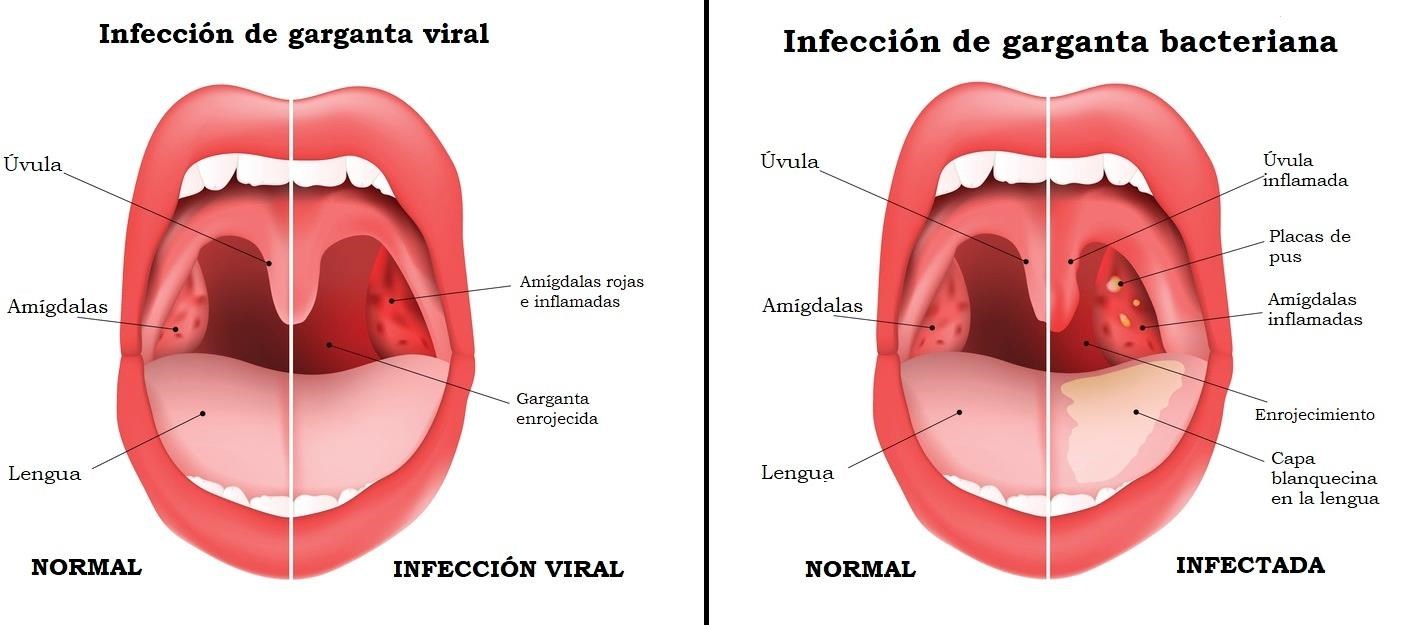 infeccion-de-garganta-viral-vs-bacteriana-1.jpg