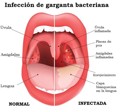 amigdalitis-bacteriana.jpg