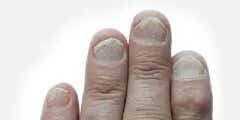 Symptoms of psoriatic arthritis - Nails