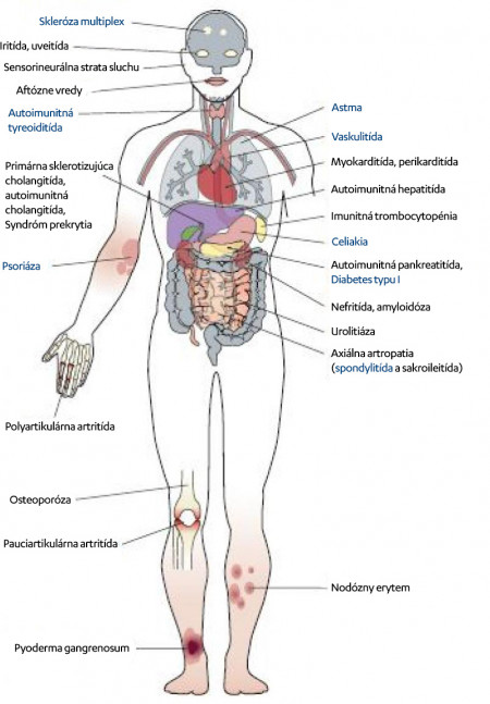 Crohn_about-disease_Čo_je_Crohnova_choroba_V2