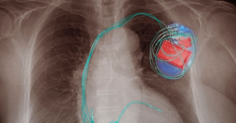 A Matter of the Heart: How Lithium Batteries Help Keep Up the Pace