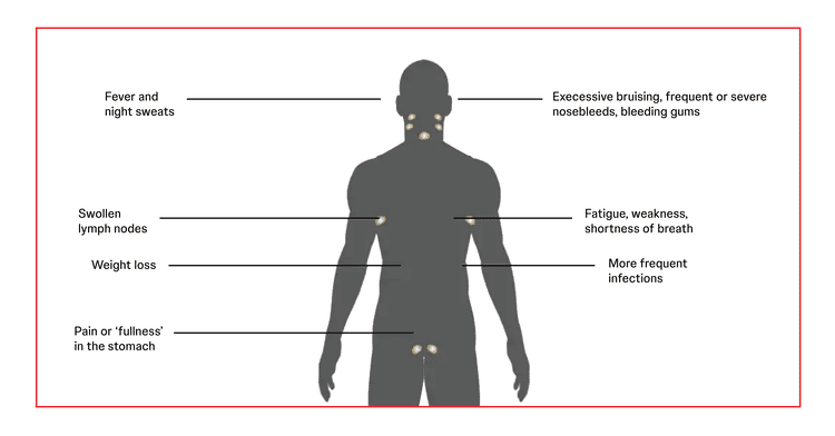 Symptoms of chronic lymphocytic leukaemia (CLL) Symptoms of chronic lymphocytic leukaemia (CLL)