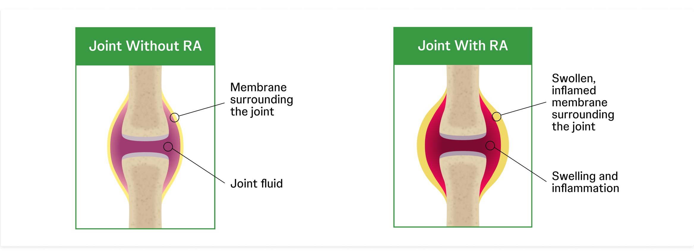 Joint with and without RA