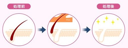 毛を毛根から抜き取るので、カミソリや除毛クリームよりも、すべすべ肌が長続きするのが特長です。