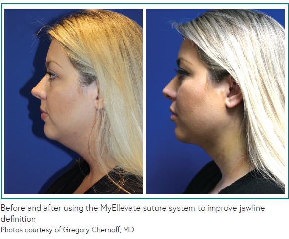 Facial Plastic Surgeon Expands Use of MyEllevate to Face and Neck