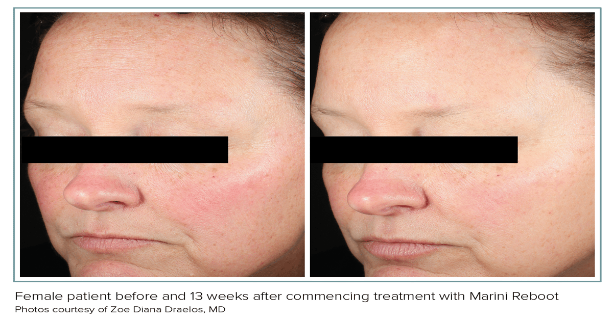 Advancing Post-Procedure Recovery and Daily Skin Repair with PDRN
