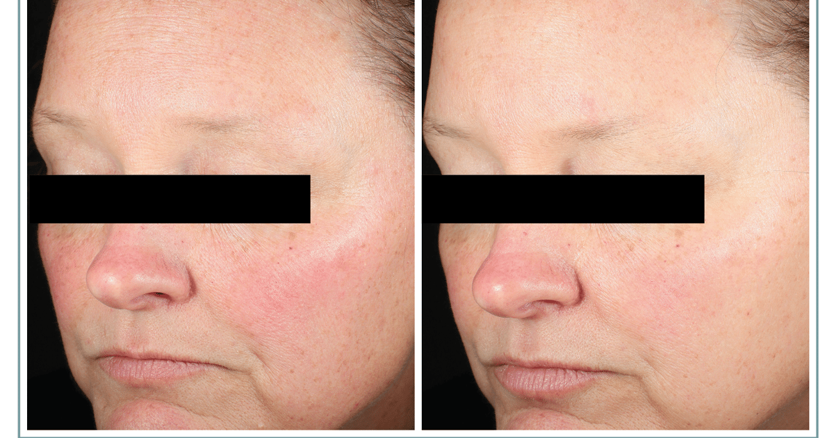 Advancing Post-Procedure Recovery and Daily Skin Repair with PDRN