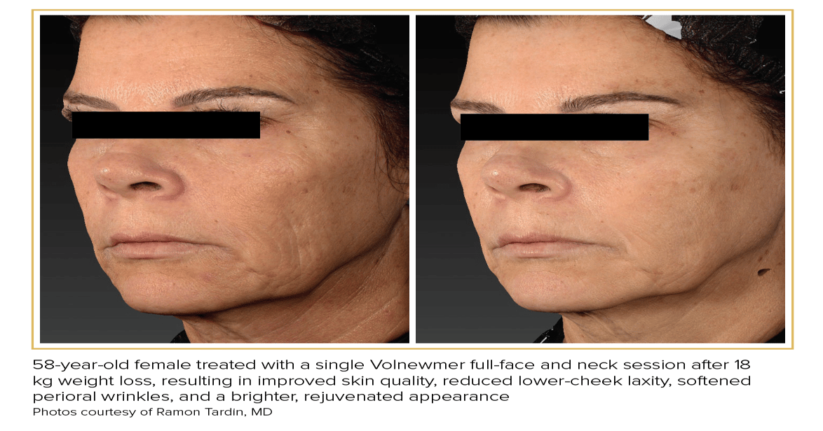 how much is semaglutide on hers How Much Does Semaglutide Cost With and Without Insurance?