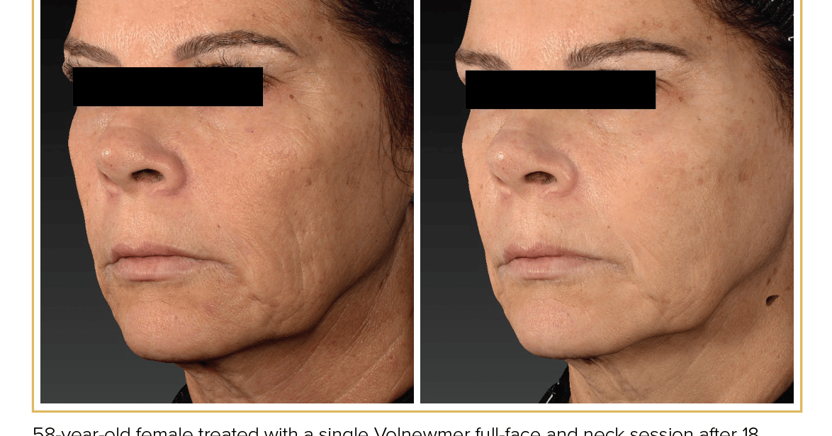 how much is semaglutide on hers How Much Does Semaglutide Cost With and Without Insurance? how much is semaglutide on hers How Much Does Semaglutide Cost With and Without Insurance?