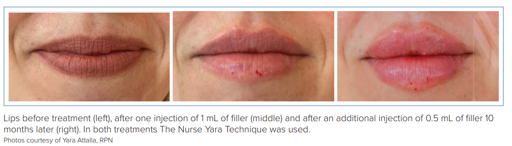 Nurse Yara's Russian Lip Technique