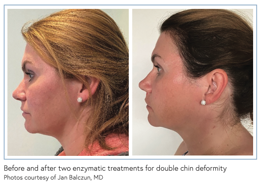 double chin post-glp-1 treatment Diminishing the Double Chin: An Enzymatic Approach