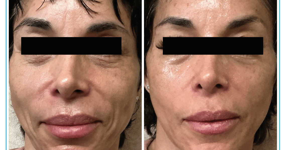 Skin Rotationplasty Skin Remodeling and Sculpting