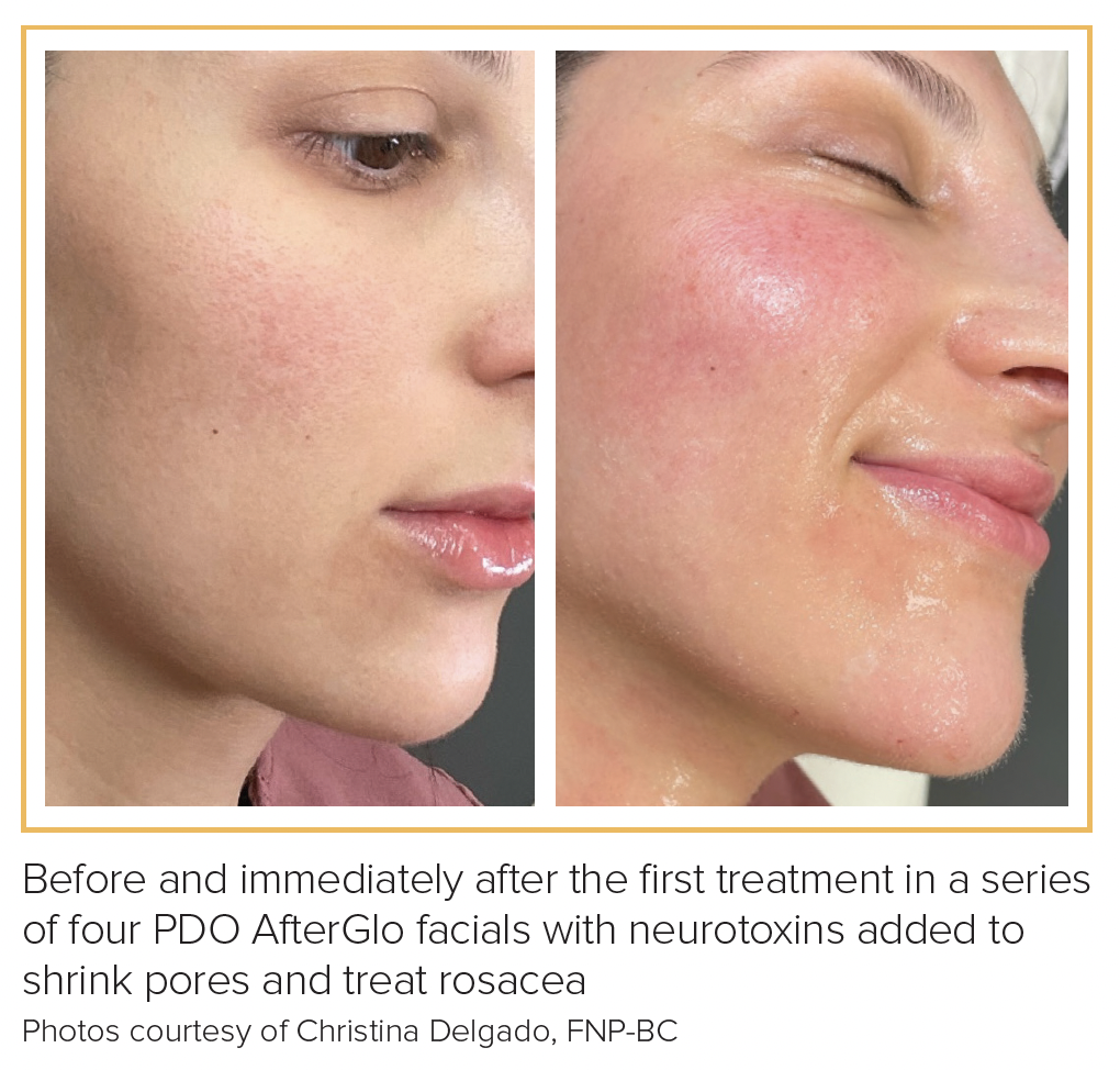 Innovations in Polydioxanone Technology Lead to New Skin Booster and ...