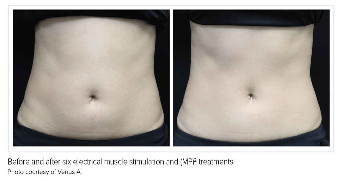 Multi-Layer Treatment Strategies: Nonsurgical Body Contouring
