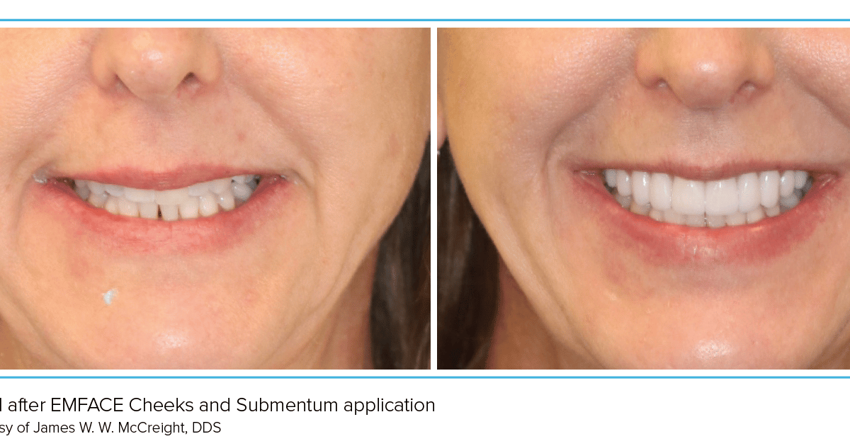 The Jawline and the Jaw Joint: A New Era of Functional Aesthetics