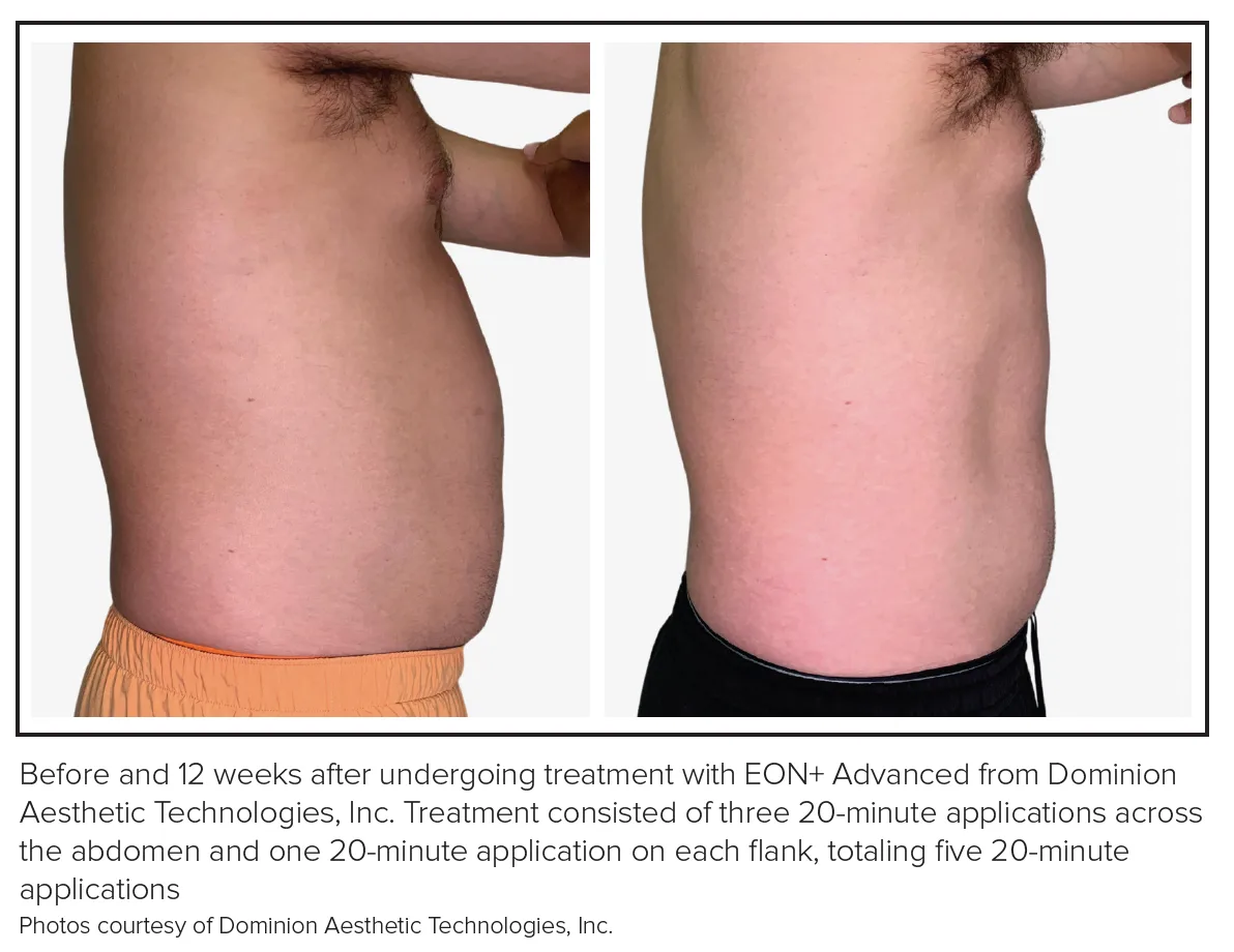 post semaglutide body contouring boston Body Shaping 2024: The Rise of Semaglutide post semaglutide body contouring boston Body Shaping 2024: The Rise of Semaglutide