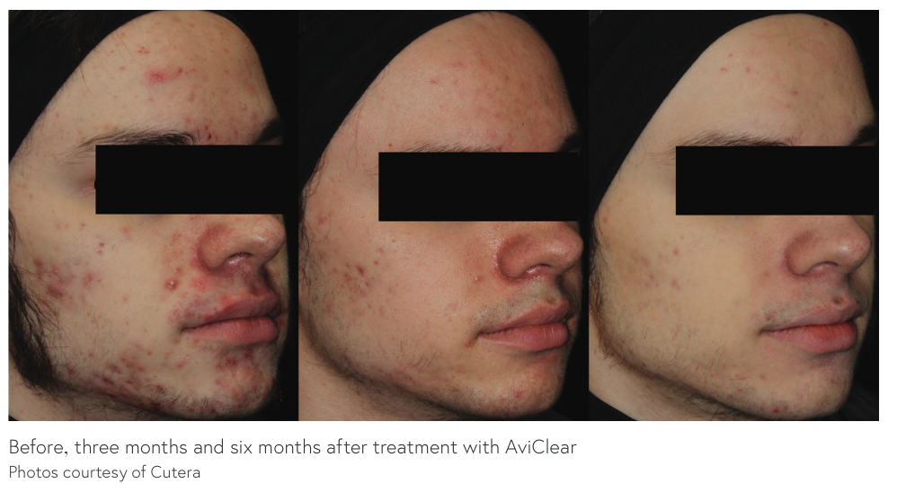 Shining a New Light on the Treatment of Acne with AviClear