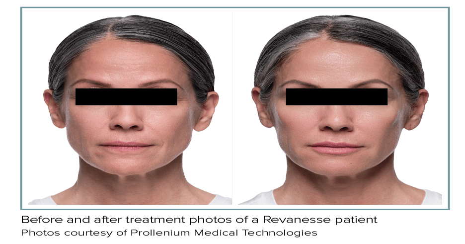 Unique Filler Formulation Provides Consistent and Reliable Results
