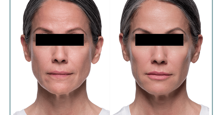 Unique Filler Formulation Provides Consistent and Reliable Results