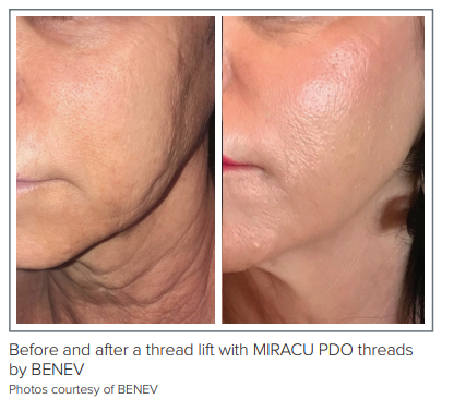 Mastering the Art of Thread Lifting: Advanced Techniques and