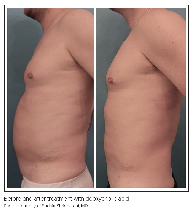 body by design semaglutide Body Shaping 2024: The Rise of Semaglutide