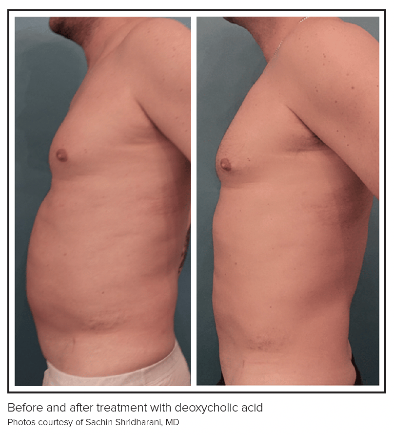 post semaglutide body contouring boston Body Shaping 2024: The Rise of Semaglutide post semaglutide body contouring boston Body Shaping 2024: The Rise of Semaglutide