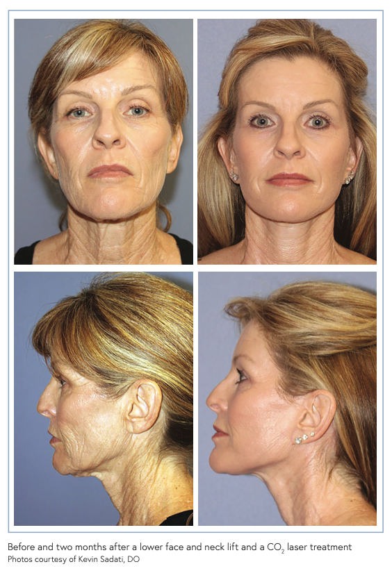 Talent & Techniques The Evolution of My Triple Layer Plication