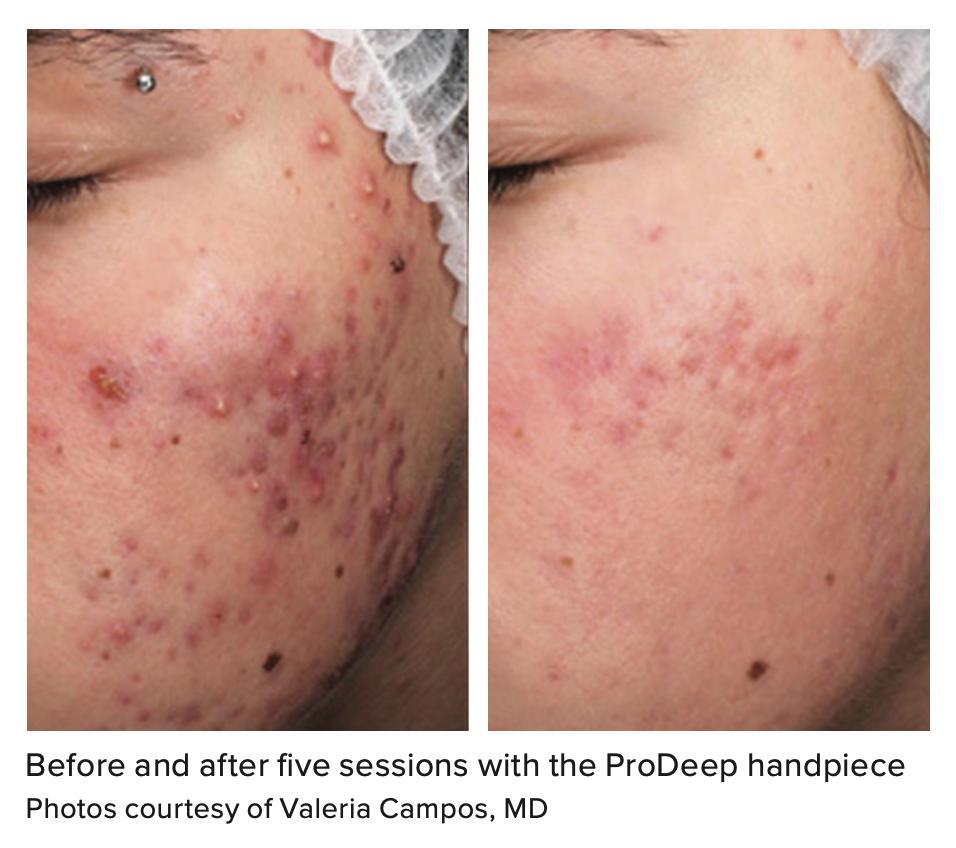 ProDeep provides new approach to traditional acne treatment methods