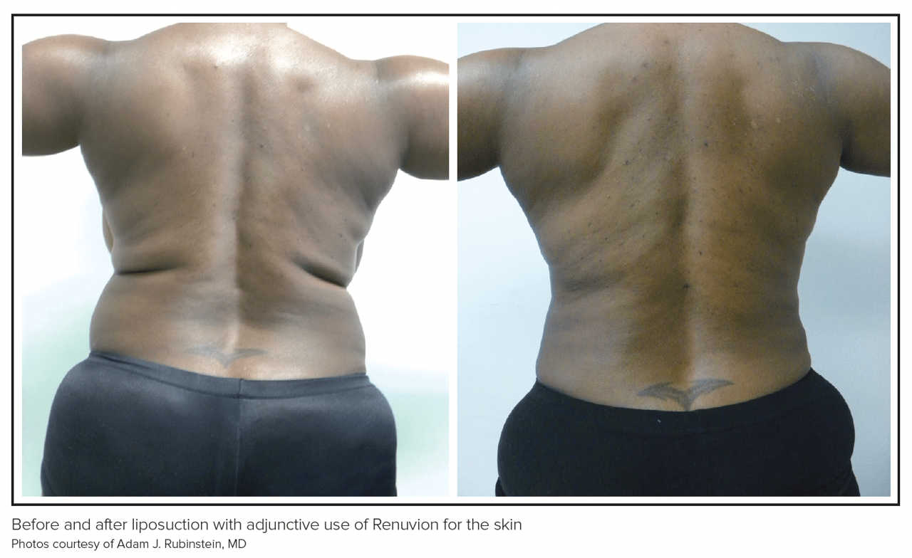 post semaglutide body contouring boston Body Shaping 2024: The Rise of Semaglutide post semaglutide body contouring boston Body Shaping 2024: The Rise of Semaglutide