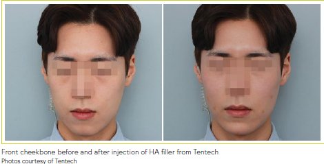 The Power of Injectables