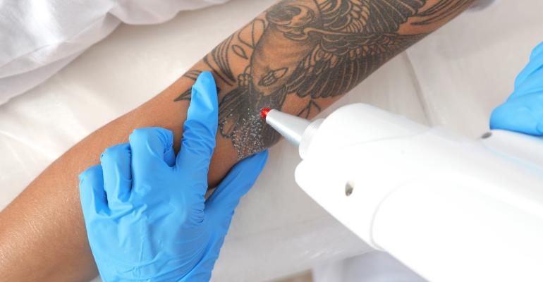7 Safety recommendations for tattoo removal