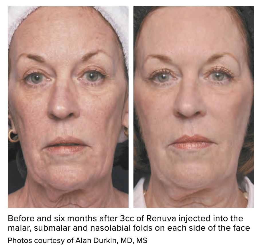 Surgeons Share Renuva Treatment Best Practice
