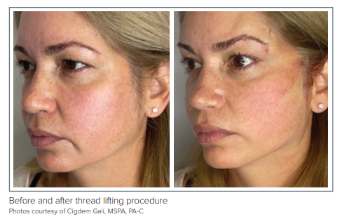 Mastering the Art of Thread Lifting: Advanced Techniques and