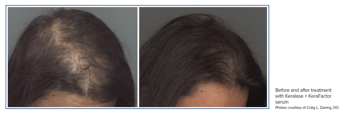 Hair Restoration: Emerging Modalities and Evidence-Based Approaches